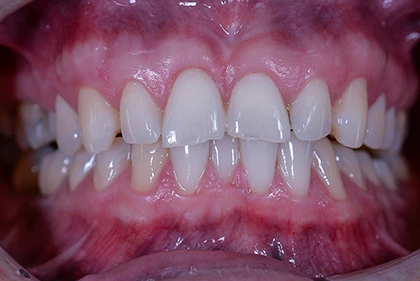 orthodontic-treatment-2