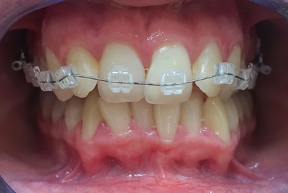 orthodontic-appliance-1