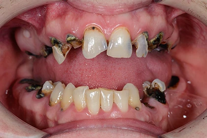 decayed-teeth-1